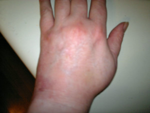 swollen and bruised hand